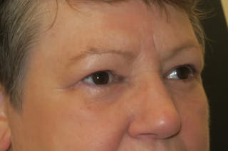 Upper Blepharoplasty (Upper Eyelid Surgery) Before & After Gallery - Patient 400208 - Image 4