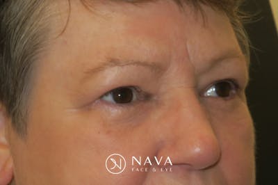 Upper Blepharoplasty (Upper Eyelid Surgery) Before & After Gallery - Patient 400208 - Image 4