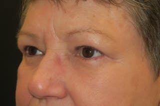 Upper Blepharoplasty (Upper Eyelid Surgery) Before & After Gallery - Patient 400208 - Image 6