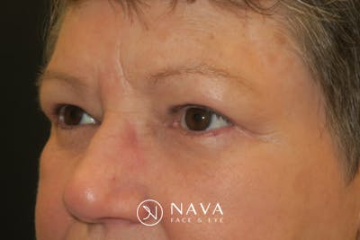 Upper Blepharoplasty (Upper Eyelid Surgery) Before & After Gallery - Patient 400208 - Image 6