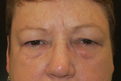 Upper Blepharoplasty (Upper Eyelid Surgery) Before & After Gallery - Patient 400208 - Image 1
