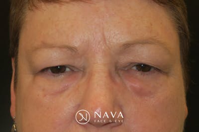 Upper Blepharoplasty (Upper Eyelid Surgery) Before & After Gallery - Patient 400208 - Image 1