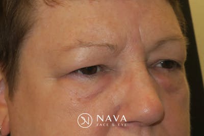 Upper Blepharoplasty (Upper Eyelid Surgery) Before & After Gallery - Patient 400208 - Image 3