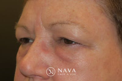 Upper Blepharoplasty (Upper Eyelid Surgery) Before & After Gallery - Patient 400208 - Image 5
