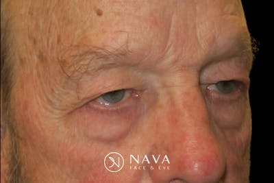 Upper Blepharoplasty (Upper Eyelid Surgery) Before & After Gallery - Patient 333674 - Image 3