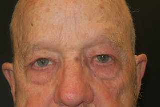 Upper Blepharoplasty (Upper Eyelid Surgery) Before & After Gallery - Patient 333674 - Image 2