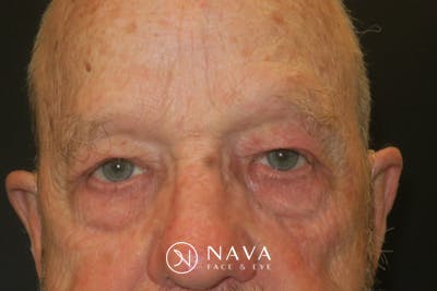 Upper Blepharoplasty (Upper Eyelid Surgery) Before & After Gallery - Patient 333674 - Image 2