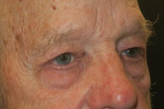 Upper Blepharoplasty (Upper Eyelid Surgery) Before & After Gallery - Patient 333674 - Image 4