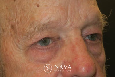 Upper Blepharoplasty (Upper Eyelid Surgery) Before & After Gallery - Patient 333674 - Image 4
