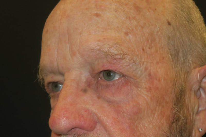 Ptosis Repair Before & After Gallery - Patient 118648 - Image 6