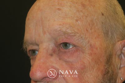 Upper Blepharoplasty (Upper Eyelid Surgery) Before & After Gallery - Patient 333674 - Image 6