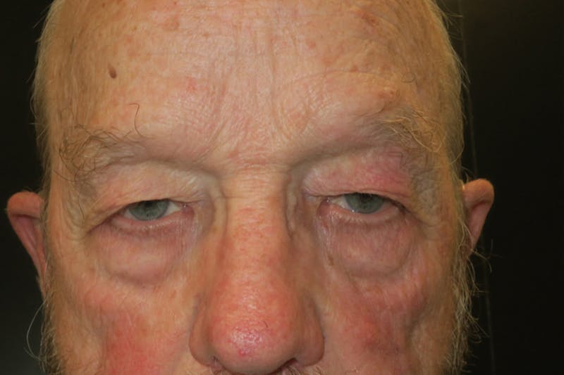 Ptosis Repair Before & After Gallery - Patient 118648 - Image 1