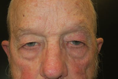 Upper Blepharoplasty (Upper Eyelid Surgery) Before & After Gallery - Patient 333674 - Image 1