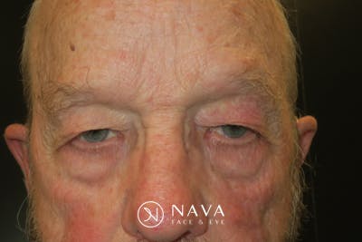 Upper Blepharoplasty (Upper Eyelid Surgery) Before & After Gallery - Patient 333674 - Image 1