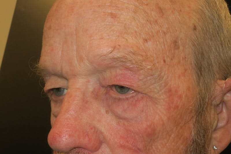 Ptosis Repair Before & After Gallery - Patient 118648 - Image 5
