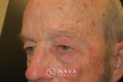 Upper Blepharoplasty (Upper Eyelid Surgery) Before & After Gallery - Patient 333674 - Image 5