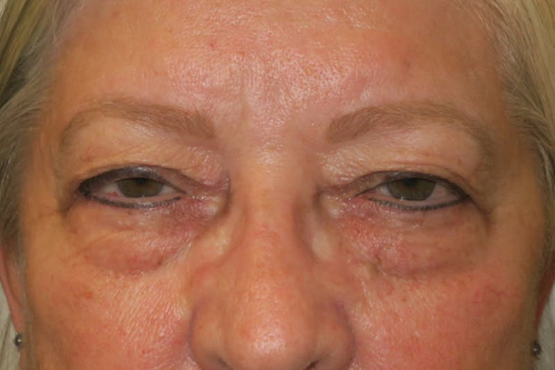 Upper Blepharoplasty (Upper Eyelid Surgery) Before & After Gallery - Patient 635927 - Image 1