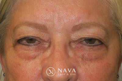 Upper Blepharoplasty (Upper Eyelid Surgery) Before & After Gallery - Patient 635927 - Image 1