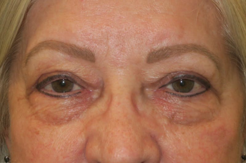 Upper Blepharoplasty (Upper Eyelid Surgery) Before & After Gallery - Patient 635927 - Image 2