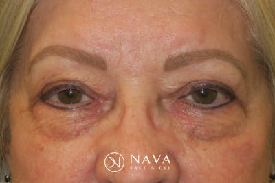 Upper Blepharoplasty (Upper Eyelid Surgery) Before & After Gallery - Patient 635927 - Image 2