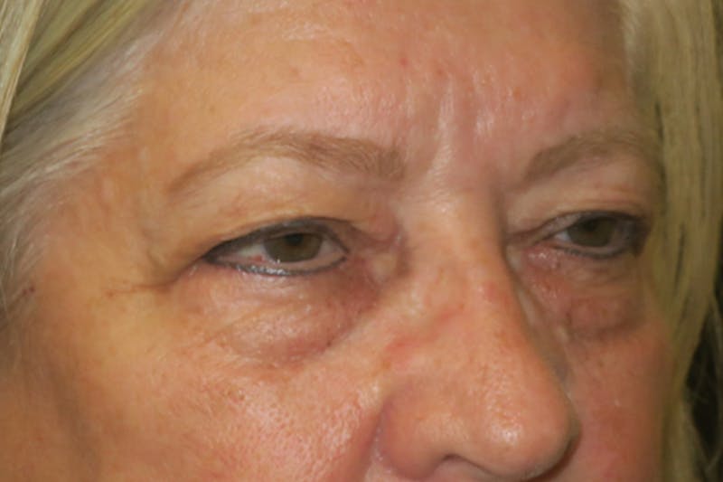 Upper Blepharoplasty (Upper Eyelid Surgery) Before & After Gallery - Patient 635927 - Image 3