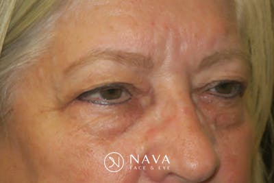 Upper Blepharoplasty (Upper Eyelid Surgery) Before & After Gallery - Patient 635927 - Image 3