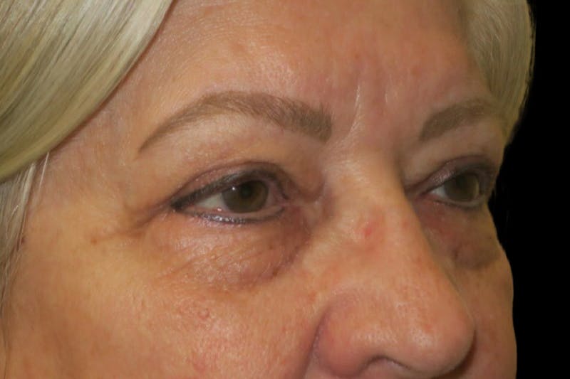 Upper Blepharoplasty (Upper Eyelid Surgery) Before & After Gallery - Patient 635927 - Image 4