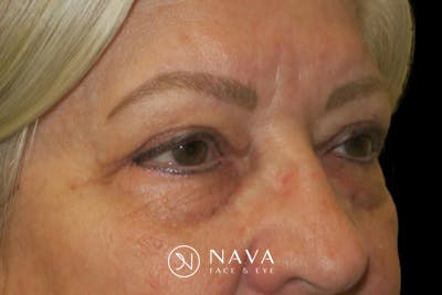 Upper Blepharoplasty (Upper Eyelid Surgery) Before & After Gallery - Patient 635927 - Image 4