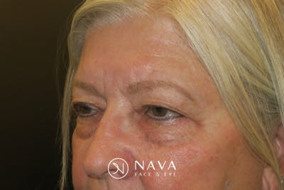 Upper Blepharoplasty (Upper Eyelid Surgery) Before & After Gallery - Patient 635927 - Image 5