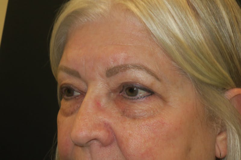 Upper Blepharoplasty (Upper Eyelid Surgery) Before & After Gallery - Patient 635927 - Image 6