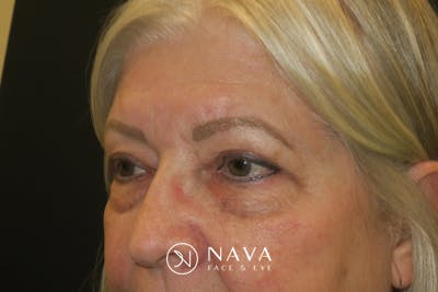Upper Blepharoplasty (Upper Eyelid Surgery) Before & After Gallery - Patient 635927 - Image 6