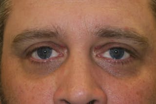 Eyelid Growth Removal Before & After Gallery - Patient 139437 - Image 2