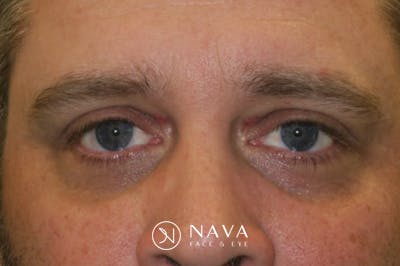 Eyelid Growth Removal Before & After Gallery - Patient 139437 - Image 2