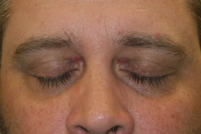 Eyelid Growth Removal Before & After Gallery - Patient 376974 - Image 4