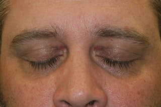 Eyelid Growth Removal Before & After Gallery - Patient 139437 - Image 4