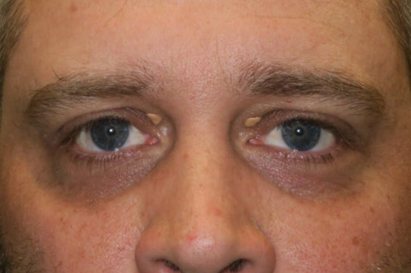 Eyelid Growth Removal Before & After Gallery - Patient 376974 - Image 1