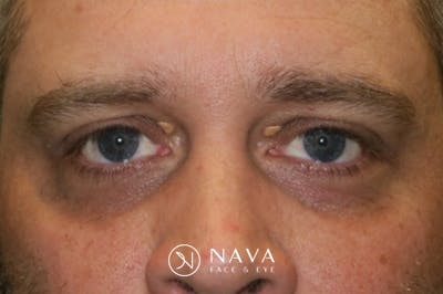 Eyelid Growth Removal Before & After Gallery - Patient 139437 - Image 1