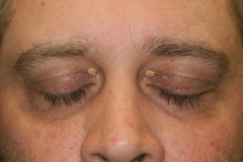 Eyelid Growth Removal Before & After Gallery - Patient 376974 - Image 3