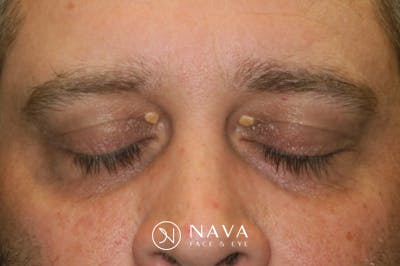 Eyelid Growth Removal Before & After Gallery - Patient 139437 - Image 3