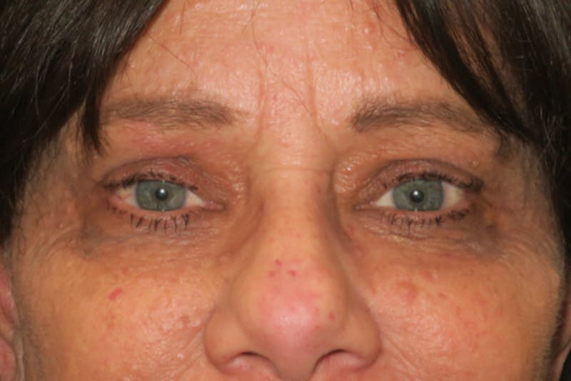 Eyelid Growth Removal Before & After Gallery - Patient 217728 - Image 2