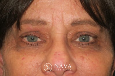 Upper Blepharoplasty (Upper Eyelid Surgery) Before & After Gallery - Patient 252123 - Image 2