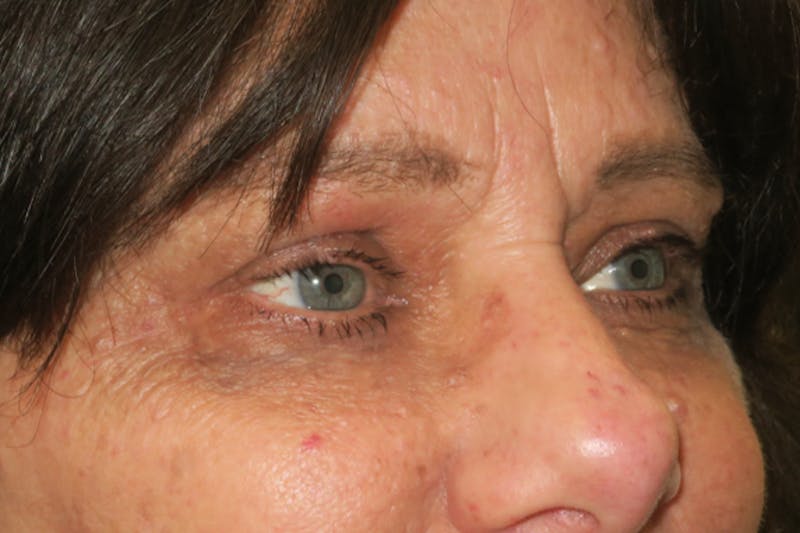 Eyelid Growth Removal Before & After Gallery - Patient 217728 - Image 6