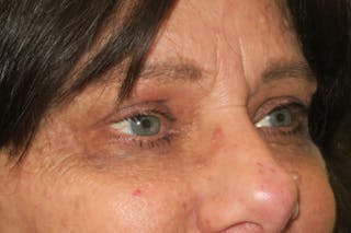 Upper Blepharoplasty (Upper Eyelid Surgery) Before & After Gallery - Patient 252123 - Image 6