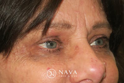 Upper Blepharoplasty (Upper Eyelid Surgery) Before & After Gallery - Patient 252123 - Image 6