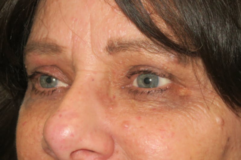 Eyelid Growth Removal Before & After Gallery - Patient 217728 - Image 4