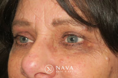 Upper Blepharoplasty (Upper Eyelid Surgery) Before & After Gallery - Patient 252123 - Image 4