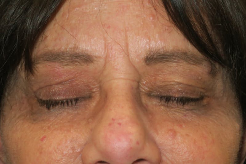 Eyelid Growth Removal Before & After Gallery - Patient 217728 - Image 8