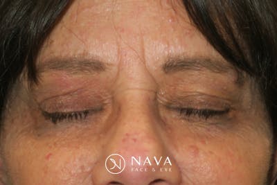 Upper Blepharoplasty (Upper Eyelid Surgery) Before & After Gallery - Patient 252123 - Image 8
