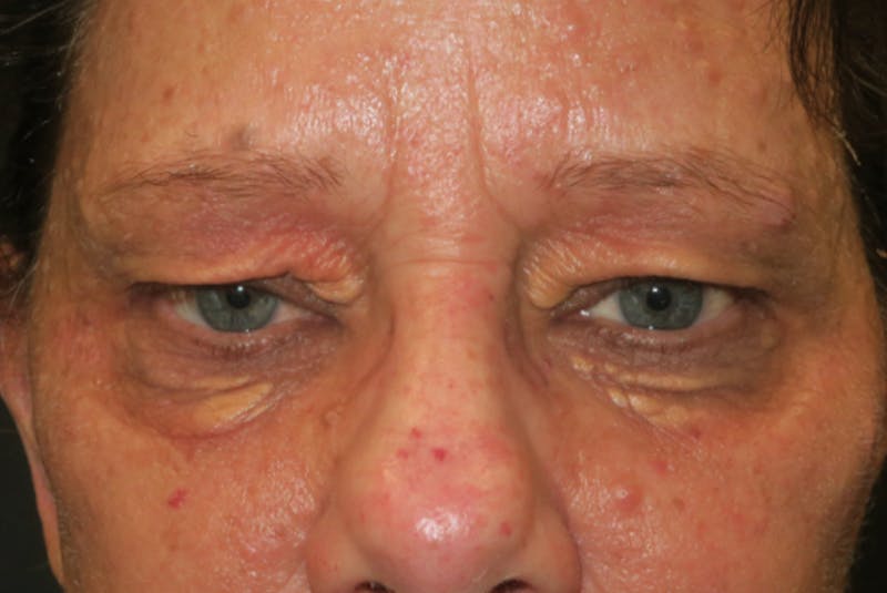 Eyelid Growth Removal Before & After Gallery - Patient 217728 - Image 1