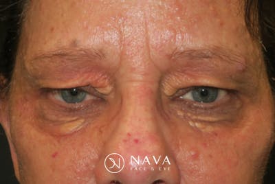 Upper Blepharoplasty (Upper Eyelid Surgery) Before & After Gallery - Patient 252123 - Image 1